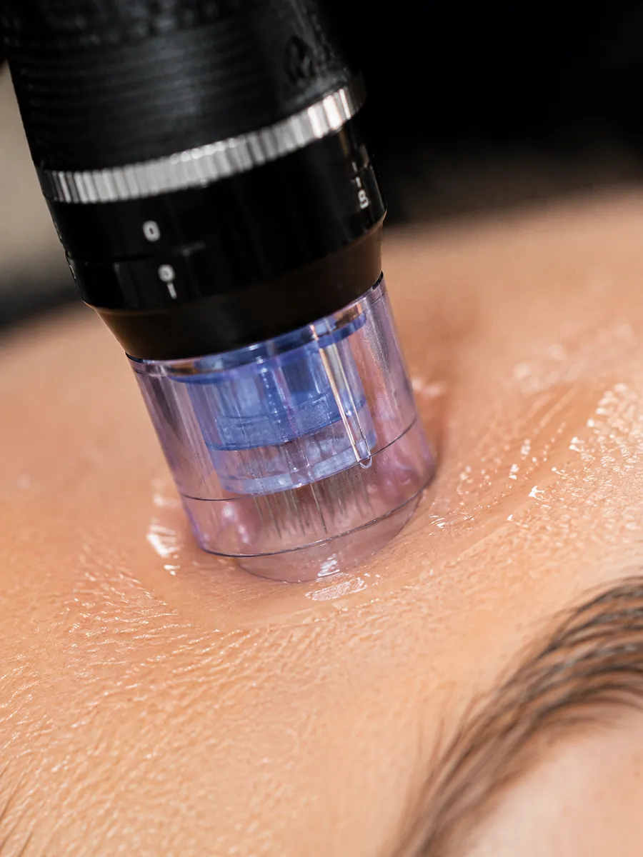 Close-up of a mesotherapy needling treatment on the skin